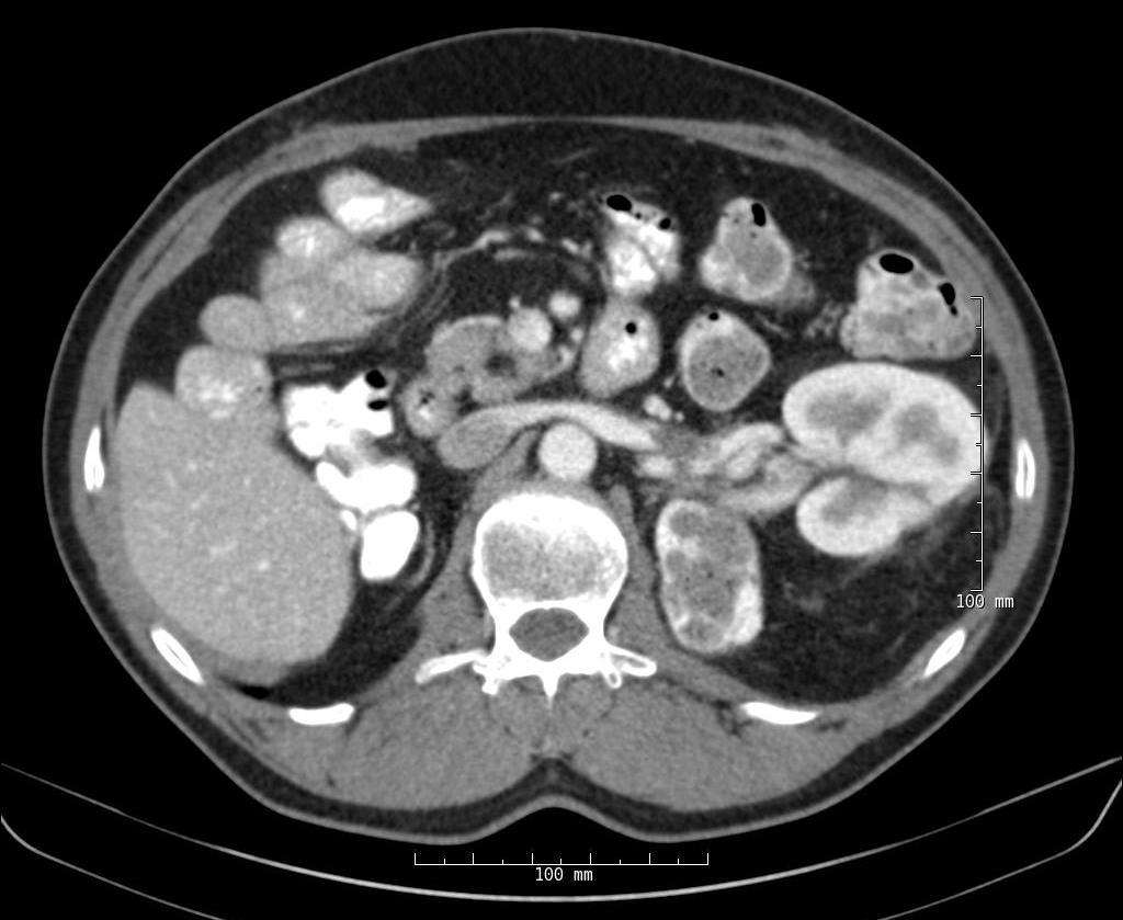 RCC in a Solitary Kidney Follow up 6 months (Jan 11) CT: