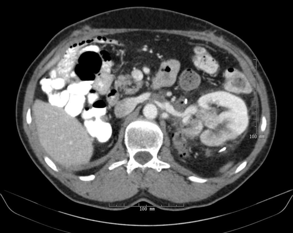 RCC in a Solitary Kidney (Mar 11) Surgery: tumor thrombus