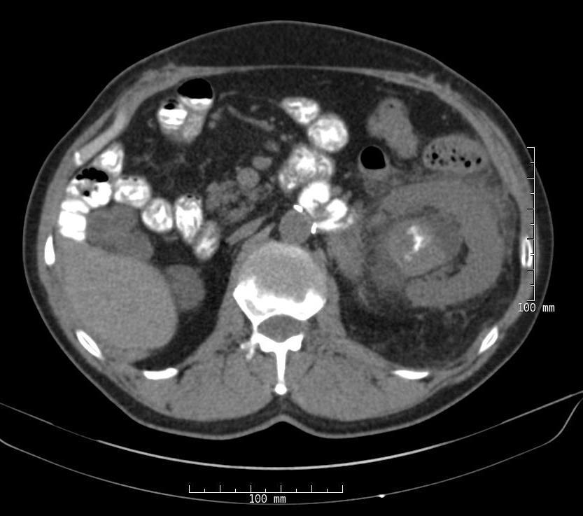 RCC in a Solitary Kidney (Jul 11) Sunitinib 50mg PO (4/2 schedule) with mild
