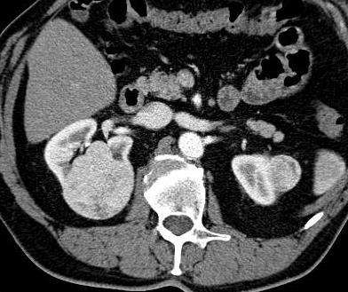 Case presentation: bilateral and multifocal renal tumors 1 large hyper vascular hilar tumor in the right kidney