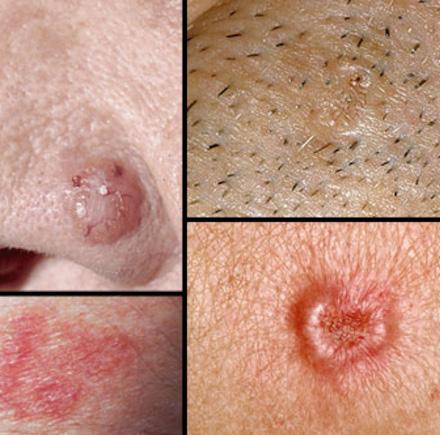 The Most Common Skin Cancers Basal cell carcinoma (BCC), or basal cell skin cancer, is the most common form.