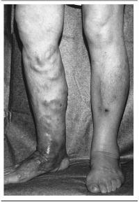 Background Post-thrombotic syndrome (PTS) affects 20-50% of patients after deep venous thrombosis PTS characterized by pain, swelling and ulceration of the affected leg PTS has a significant impact