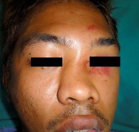 OriginalArticle Silastic Nasal Septal Splint: A Key Success in the Treatment of Acute Nasal Bone Fractures Kriangsak Sirirak, M.D.