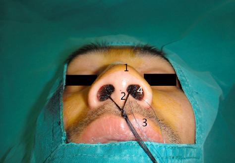 Small stainless steel wire was used to fix the caudal septum at the maxillary crest, maintaining the precise position of the septum. A nasal septum splint was done as in closed reduction.