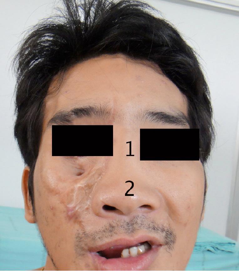 Immediate postoperative appearance (4d): good nasal tip projection (1), straighten nasal columella and septum (2), tail of sutures (3), and patent caudal nasal airway (4).