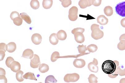 Blood Cell Identification Graded Case History The patient is a 20-year-old female with sickle cell disease who presents with bilateral leg pain for 3 days.