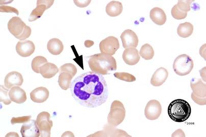 Blood Cell Identification Graded BCP-12 Neutrophil, segmented or band Neutrophil w/dysplastic nucleus and/or agranular cytoplasm Neutrophil, toxic (to include toxic granulation and/or Döhle bodies,