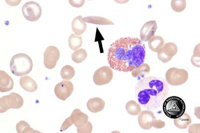 Blood Cell Identification Graded BCP-14 Sickle cell (drepanocyte) 32 97.0 5340 97.9 Good Fragmented red cell 1 3.0 12 0.