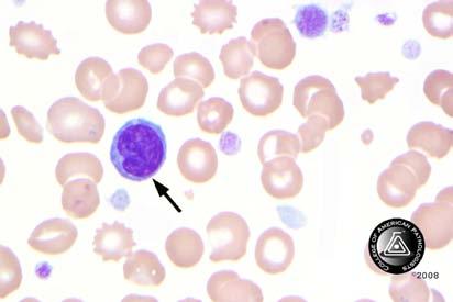 Blood Cell Identification Ungraded BCP-18 Lymphocyte 25 96.1 4377 82.1 Educational Monocyte, immature 1 3.9 47 0.9 Educational (promonocyte, monoblast) Lymphocyte, reactive (to - - 444 8.