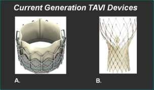 TAVI Endocarditis: Echocardiography Presence of vegetations 52% Vegetation size, median 15 mm Perivalvular abscess/fistula 45% Mitral valve vegetation 13% Look for false aneurysm Paravalvular