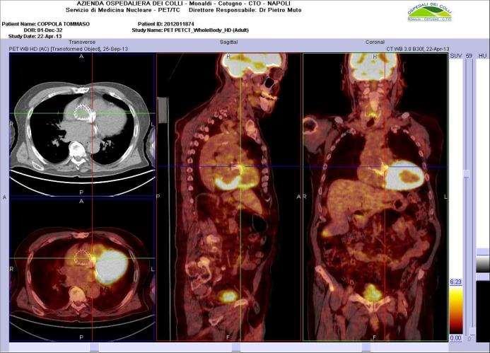 18FDG-PET-CT scan: usefulness