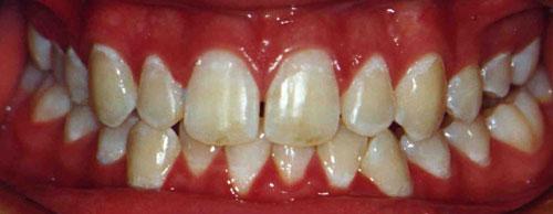 I developed the upper arch using a Biobloc expansion appliance and aligned the upper teeth with a fixed appliance.