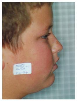 9 July 2006 The negative effect of mouth breathing on the body and development of the child 4 Postural Implications of Chronic Mouth-breathing Children who are chronic mouth breathers will tend to