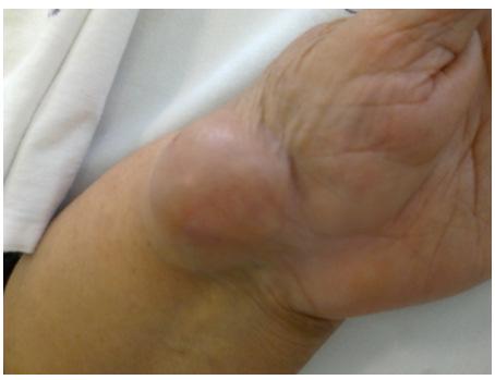 Figure 1(a):The Ganglion on the Radial Volar Aspect of the Wrist, Extending Slightly Dorsally Figure