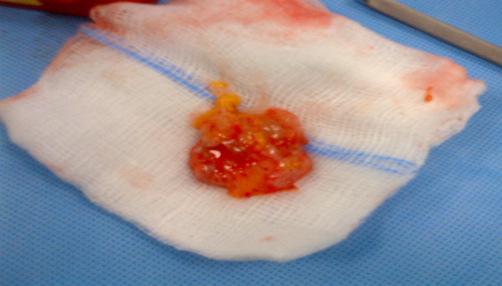 lesion. The lesion was removed surgically. The lesion was approached laterally by an incision 8-10 cm long.