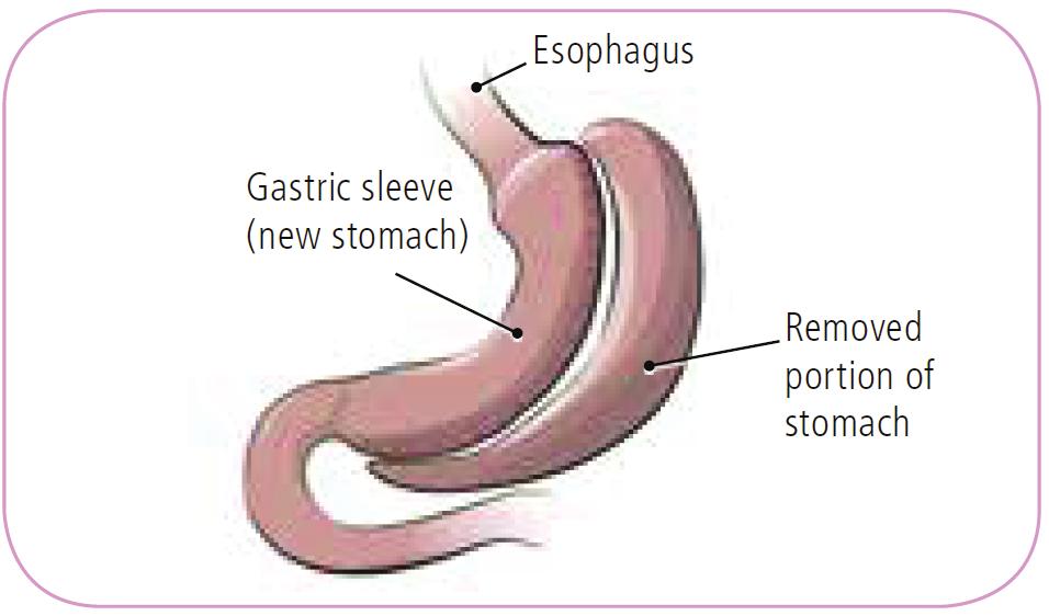 Bariatric surgery is often performed using minimally invasive surgery.