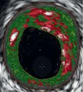 High Plaque Structural Stress (PSS) to predict Rupture 4053 VH-IVUS frames from 32 fibroatheroma