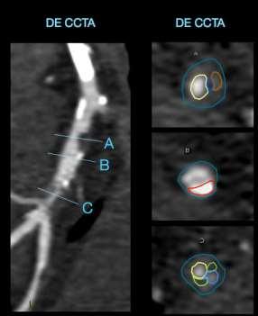 Atherosclerotic Plaque Characterization Dual Energy Coronary CT Angiography 100% accuracy for necrotic core (primary feature of vulnerable plaque Atherosclerotic plaque