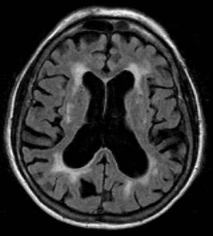 MRI and CSF in MCI: what do the results mean?