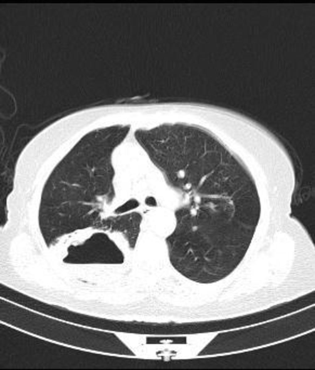 Fig. 2: Axial CT showed the cavitary lung lesson