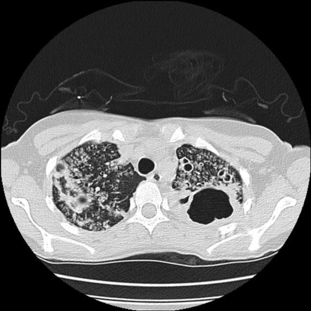 Fig. 3: Axiial CT image of an another patent with cavitary lung lesion at the left and