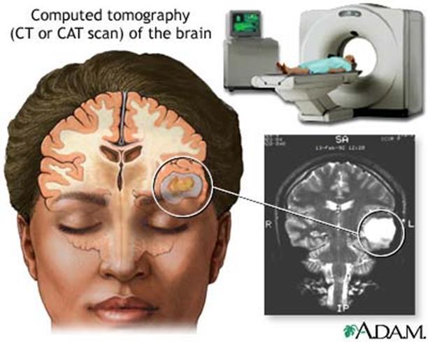 CAT Scans Computerized Axial Tomography (CAT-scan) Uses X-rays to create a 3-dimensional image of the brain CT scans can often