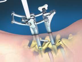 8. Placement of Ballista Rod With the C/D instrument attached, tissue elevators are advanced from screw head to screw head through the screw towers to initiate a path through the soft