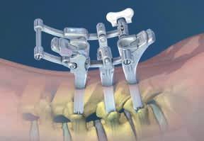 load it onto the rod introducer. To load the percutaneous rod onto the rod introducer, use the following steps: O.R.