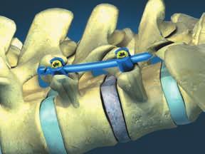 11. Removal of the Percutaneous Screw Towers and Closure Remove the Counter Torque Instruments from the construct.