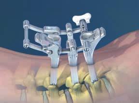 Features and Benefits Features True Percutaneous System Cannulated Screws Helical Flange Technology Exclusive Rod Design Unique Screw Towers 5.