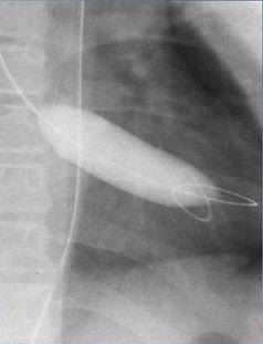 Balloon Valvuloplasty The aortic valve is similar to the