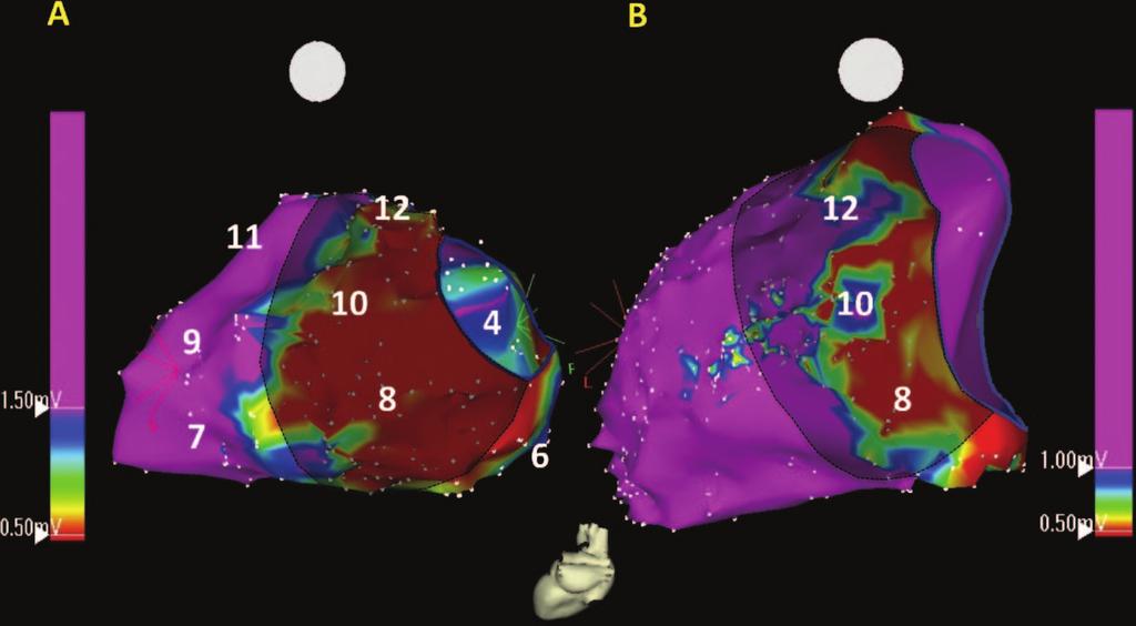 64 Circ Arrhythm Electrophysiol February 2010 Figure 1. A, Left posterior oblique view of a bipolar ENDO voltage map in sinus rhythm shows the typical distribution of low voltage ( 1.