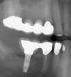 Today, I would not place abutments on the implants, as in the photo, but rather would connect the splinted crowns to the implants by screwing through the crowns into the implants. Fig.