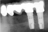 Minimizing the number of implants is an option, but it may require connecting the implant to a natural tooth. Fig. 1 shows a potential need for attachment of a natural tooth to an implant.