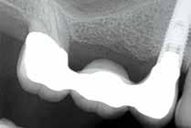 Inadequate quantity or quality of bone. Grafting bone is a common procedure, but it s not done by many general dentists.