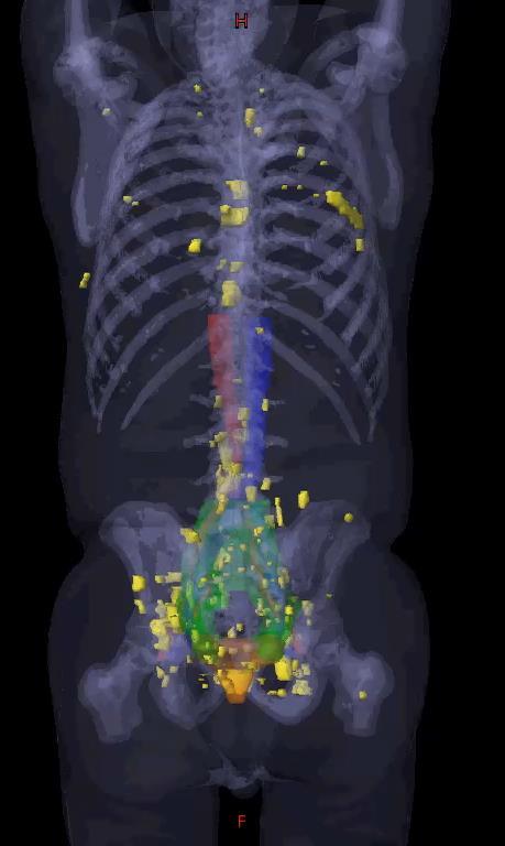 3D MAPPING OF RECURRENCES 132/270 (49%) positive 68 Ga-PSMA PET/CT 52/270 (19%) at least one PSMA avid lesion not covered by consensus CTVs.