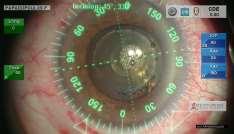 State-of-the-Art Refractive Lens Surgery Femtolaser and Image Guided Systems have