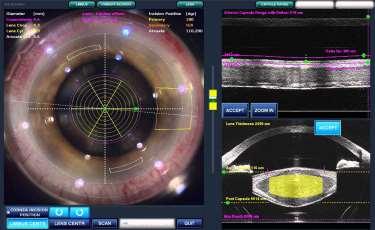 State-of-the-Art Refractive Lens Surgery Intrastromal