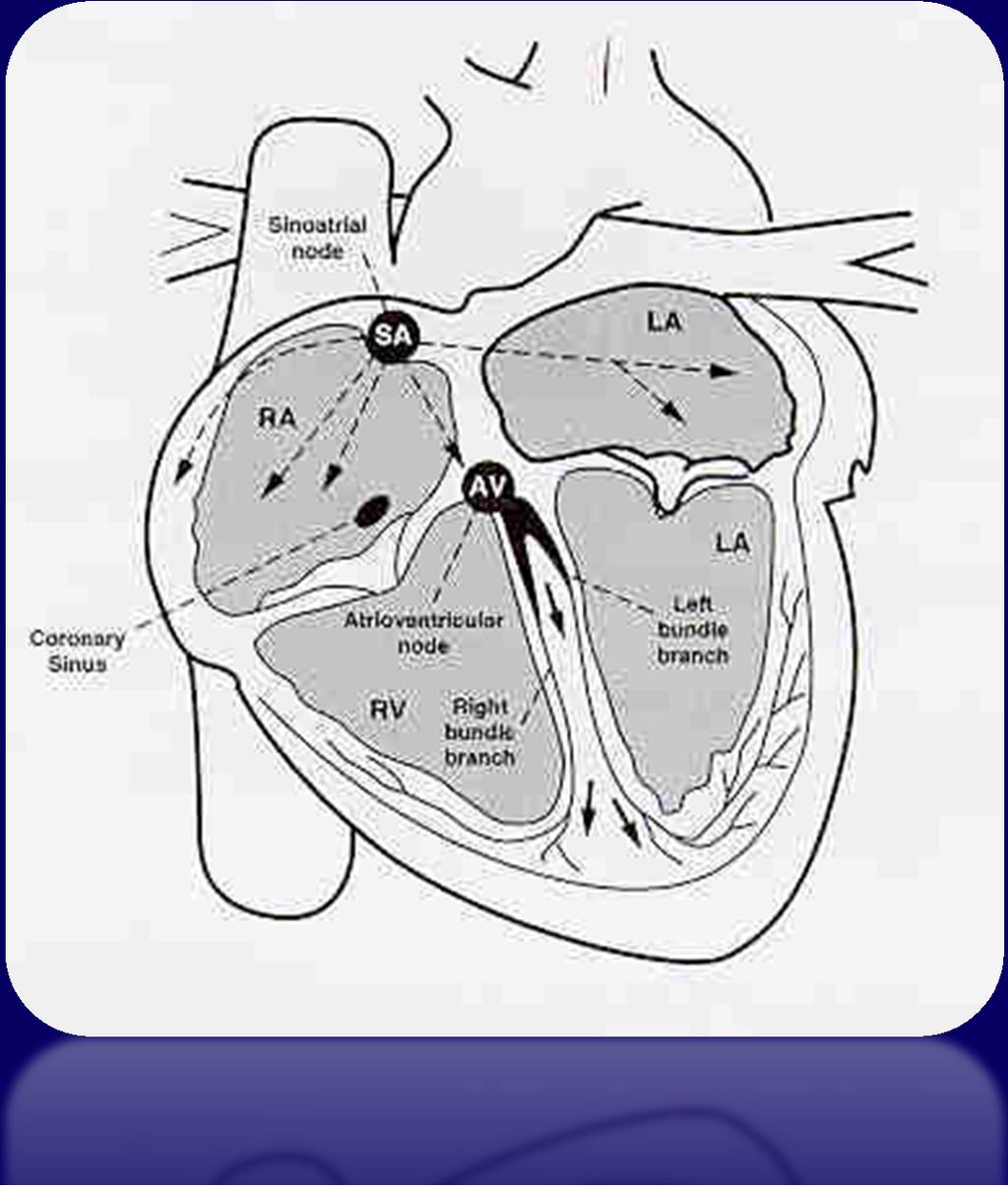 AVRT vs AVNRT AVRT: Atrio-Ventricular Re-entrant Tachycardia Accessory Pathway