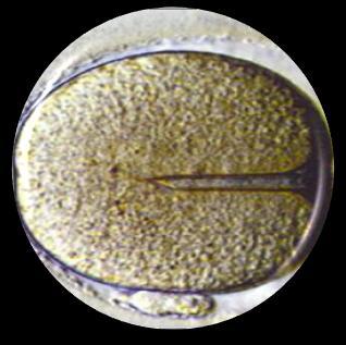 1995 Necrozoospermia secondary to genital