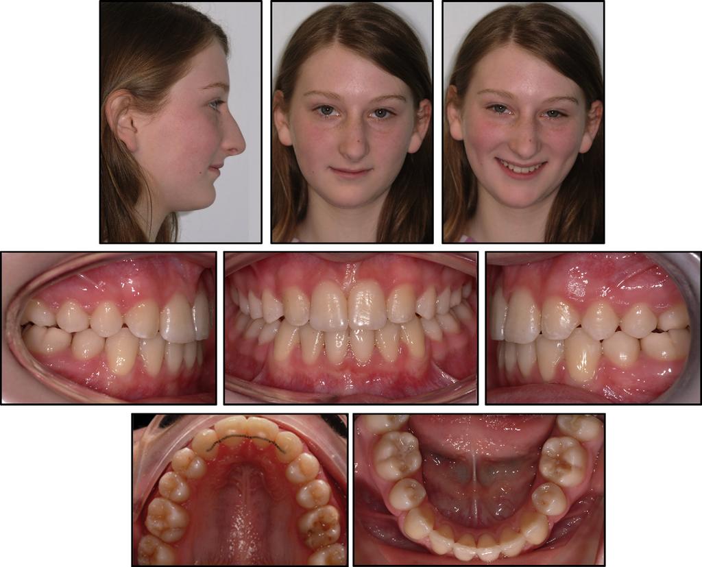Al-Anezi 695 Fig 6. Posttreatment clinical photographs. interincisal angle was also reduced to an average value of 130 (Fig 9).