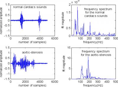 Figure 2 Figure 1: Frequency spectrum for the normal cardiacs sounds and the sounds S1 and S2.