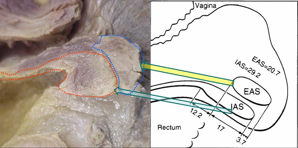 Posterior Compartment and Anal Sphincters The posterior vagina is supported by connections between the vagina, the bony pelvis, and the levator ani muscles.
