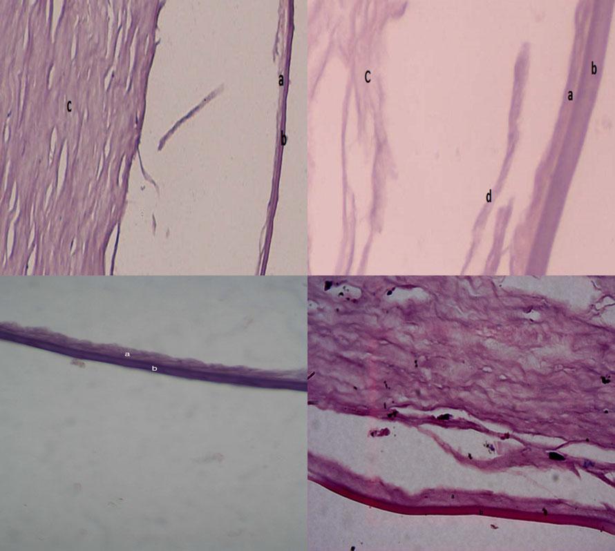 Fig. 2. Histological appearance of a dissected graft with the presence of Dua s layer. (a) Dua s layer. (b) Descemet s membrane. (c) Stroma. (d) Strands of collagen bundles. Table 1.