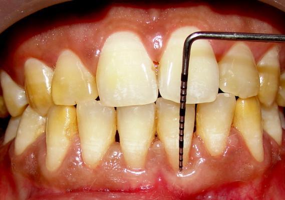 A detailed case history was taken followed by clinical examination which revealed Miller s class I gingival recession in #31 and #41{Figure 1(a) and Figure 1(b)} with a healthy residual periodontium.