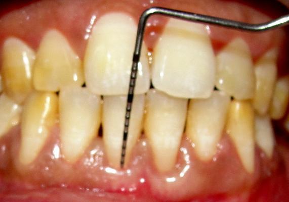 Figure 1(b):Showing 3mm of gingival recession