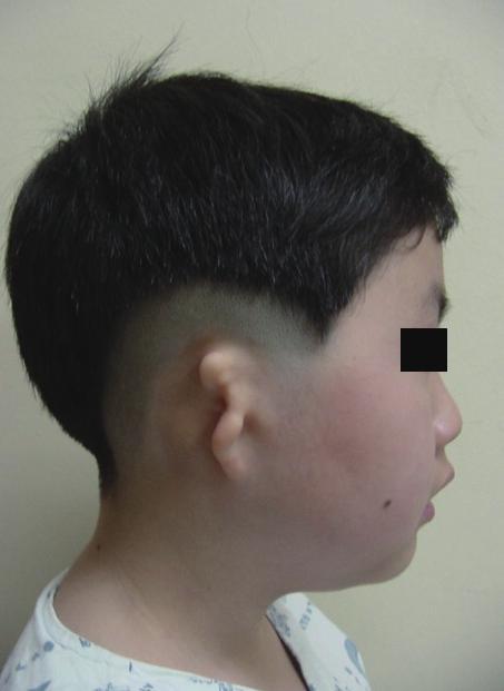Vol. 40 / No. 3 / May 2013 Fig. 2. n 11-year-old patient with right-sided microtia () Preoperative view.