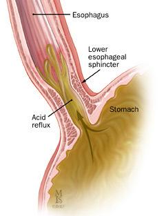 However, reflux is only considered a disease when it causes frequent or severe symptoms or when it produces injury. About 3 7% of the U.S. population suffers from frank esophageal reflux disease.