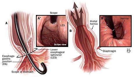 Figure 4. Mechanism of gastroesophageal reflux disease. A weak antireflux barrier causes reflux in the majority of patients (Figure 4).