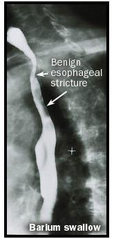 Esophagitis may range in severity from microscopic changes in biopsies taken from an endoscopically normal-looking esophagus (microscopic esophagitis), to obviously inflamed-looking mucosa without
